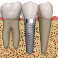 имплантация зубов